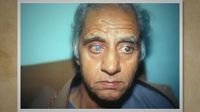 'Video thumbnail for Clear Vision Ahead: Understanding Cataracts and Your Treatment Options'