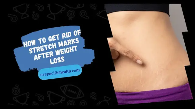 'Video thumbnail for How to Get Rid of Stretch Marks After Weight Loss'